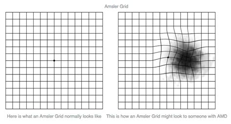 amsler grid results|amsler grid test interpretation.